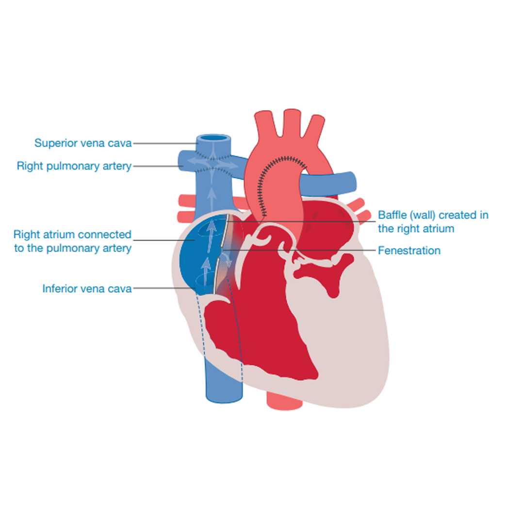 Hypoplastic Left Heart Syndrome - Little Hearts Matter