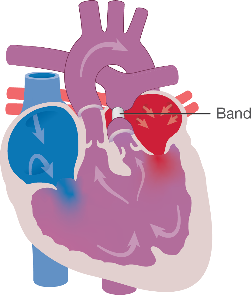 Double Outlet Right Ventricle (DORV) - Little Hearts Matter
